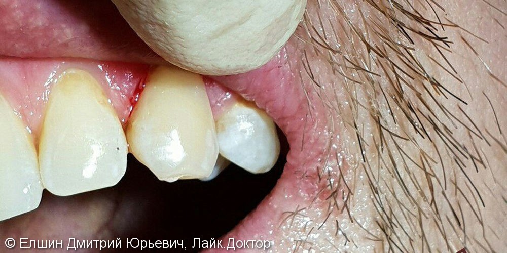 Пришеечный кариес 2.3 зуба, до и после лечения - фото №2