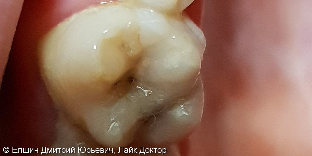 Результат лечения глубокого кариеса зуба 1.6, материал Filtek Z 250 - фото №1