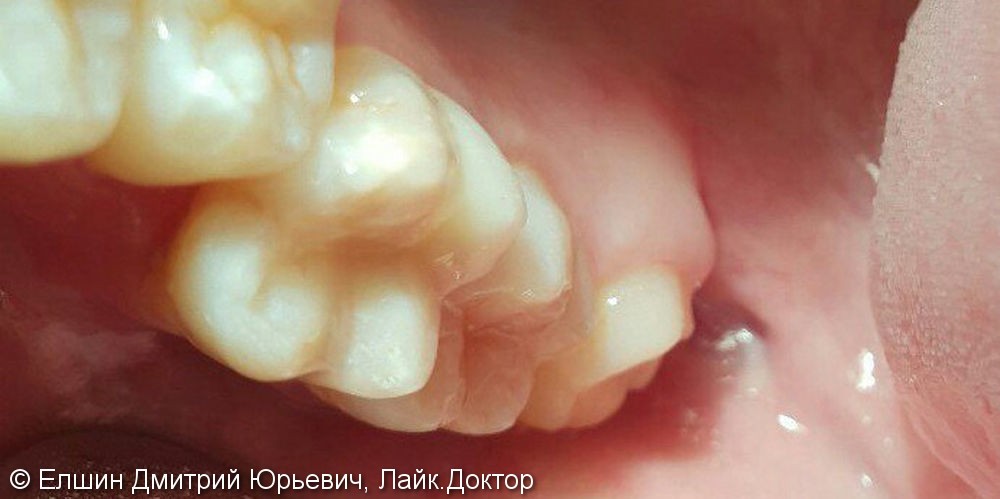 Результат лечения глубокого кариеса зуба 1.6, материал Filtek Z 250 - фото №3