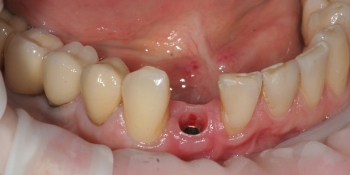 Отсутствие зуба на нижней челюсти - фото №1