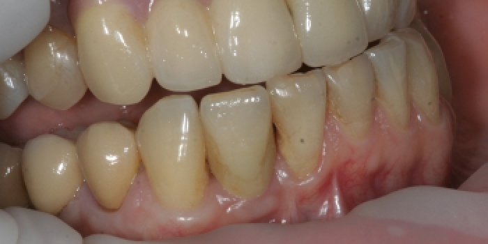 Отсутствие зуба на нижней челюсти - фото №2