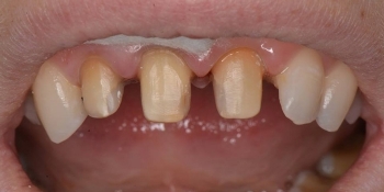 Восстановление зубов керамическими коронками Емах - фото №1