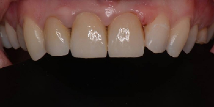 Восстановление зубов керамическими коронками Емах - фото №2