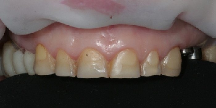 Восстановление зубов керамическими коронками из оксида циркония - фото №1