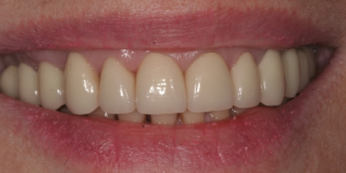 Восстановление зубов керамическими коронками из оксида циркония - фото №2
