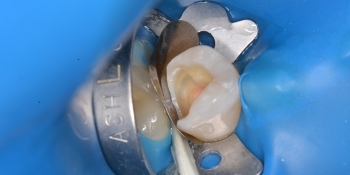 Лечение зуба с применением коффедрама - фото №1