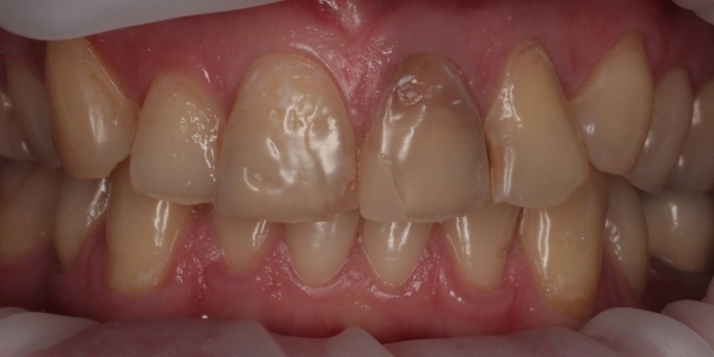 Восстановление зубов безметалловыми тонкостенными коронками - фото №1