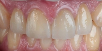 Восстановление зубов безметалловыми тонкостенными коронками - фото №2