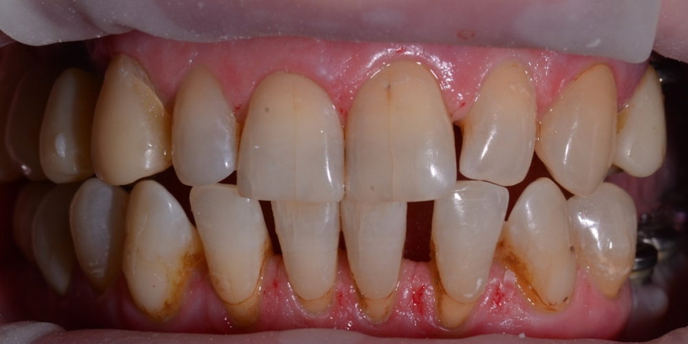 Восстановление отсутствующих зубов имплантатами и безметалловыми коронками - фото №1