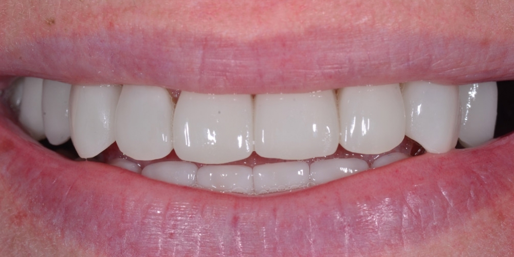 Восстановление отсутствующих зубов имплантатами и безметалловыми коронками - фото №3
