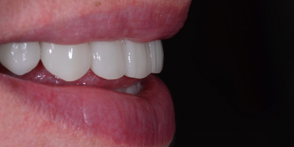 Восстановление отсутствующих зубов имплантатами и безметалловыми коронками - фото №2