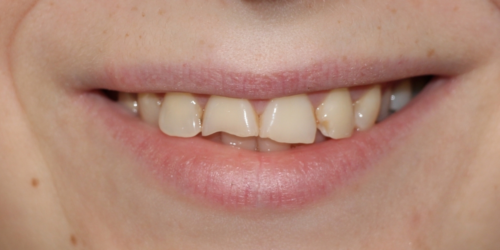 Восстановление зубов керамическими винирами - фото №1