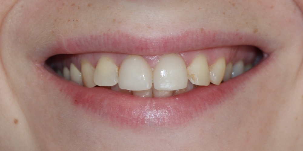Восстановление зубов керамическими винирами - фото №2