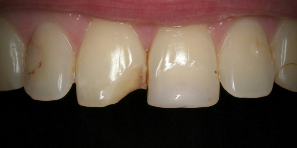 Эстетическая реставрация переднего зуба композитными материалами - фото №1