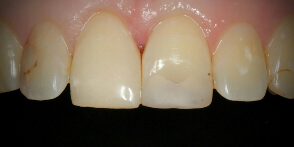 Эстетическая реставрация переднего зуба композитными материалами - фото №2