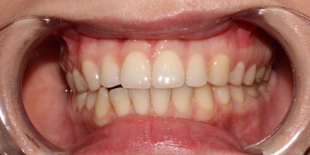 Фото результата отбеливание зубов с помощью системы Zoom 3 - фото №1