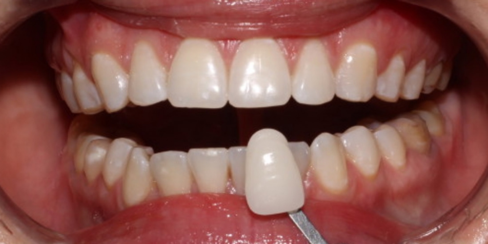 Фото результата отбеливание зубов с помощью системы Zoom 3 - фото №2