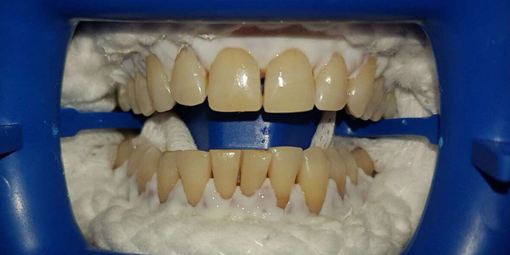 Результат отбеливания зубов ZOOM-3 - фото №1