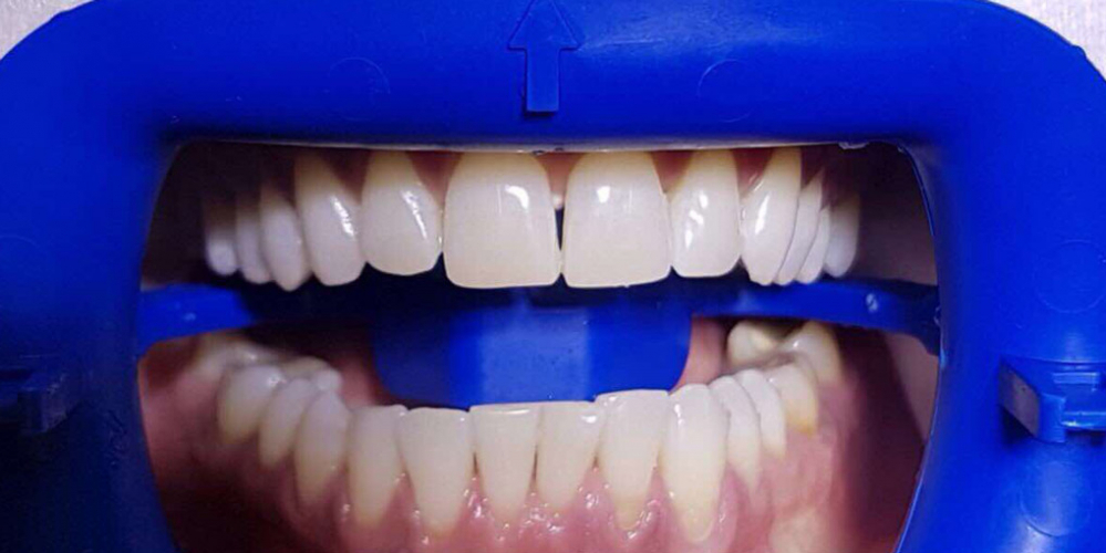 Результат отбеливания зубов ZOOM-3 - фото №2