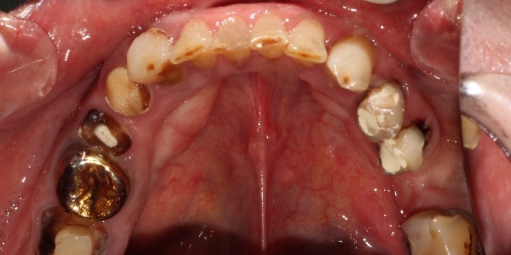 Протезирование жевательных зубов металлокерамическими коронками - фото №1