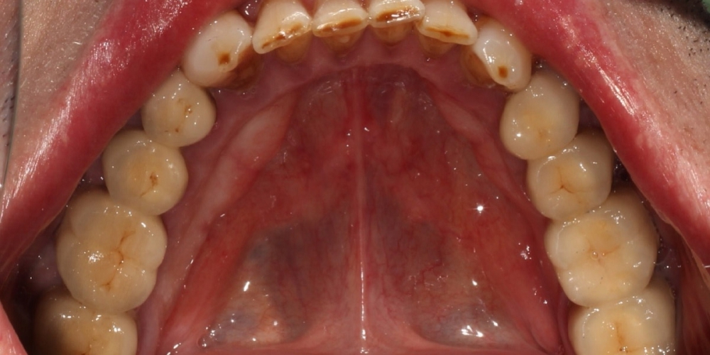 Протезирование жевательных зубов металлокерамическими коронками - фото №2