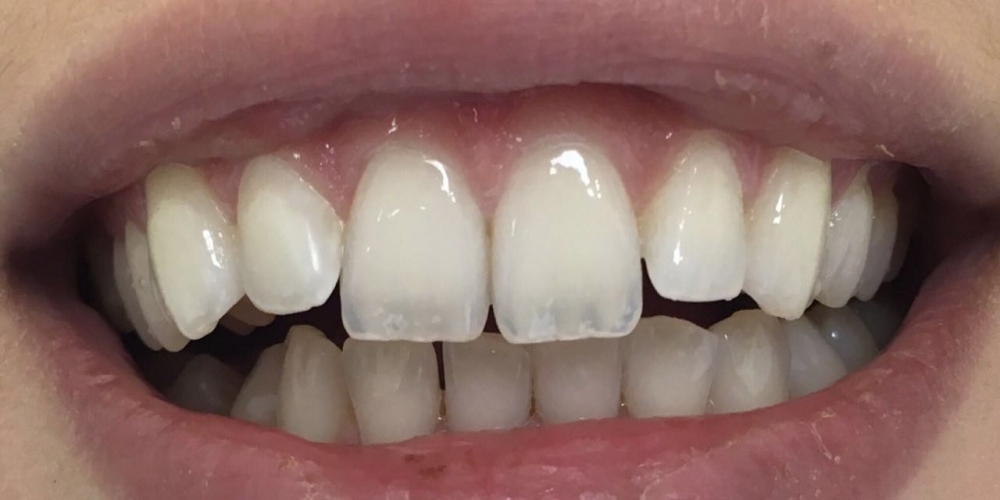 Результат отбеливания зубов с помощью системы Zoom 3 - фото №1