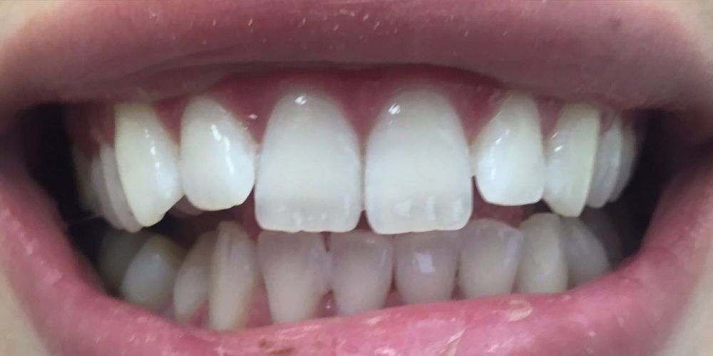 Результат отбеливания зубов с помощью системы Zoom 3 - фото №2
