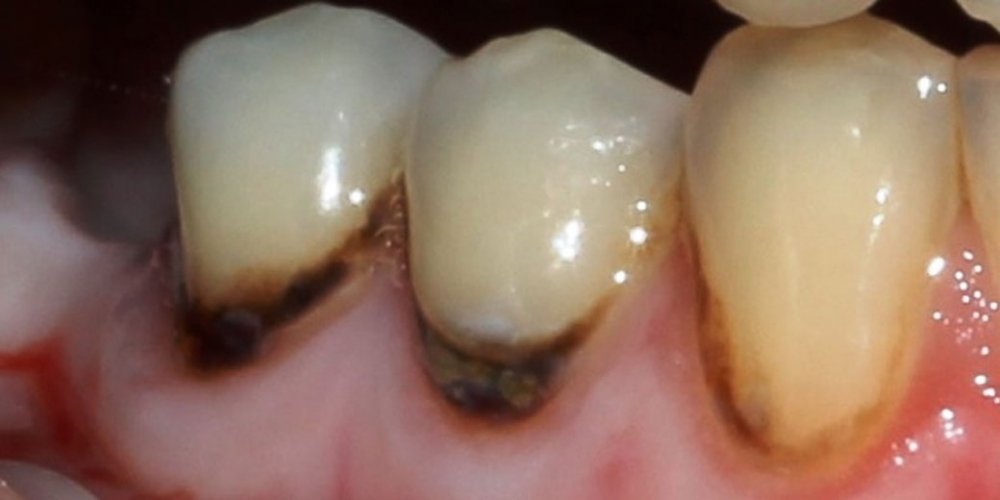 Результат лечения пришеечного кариеса зубов - фото №1