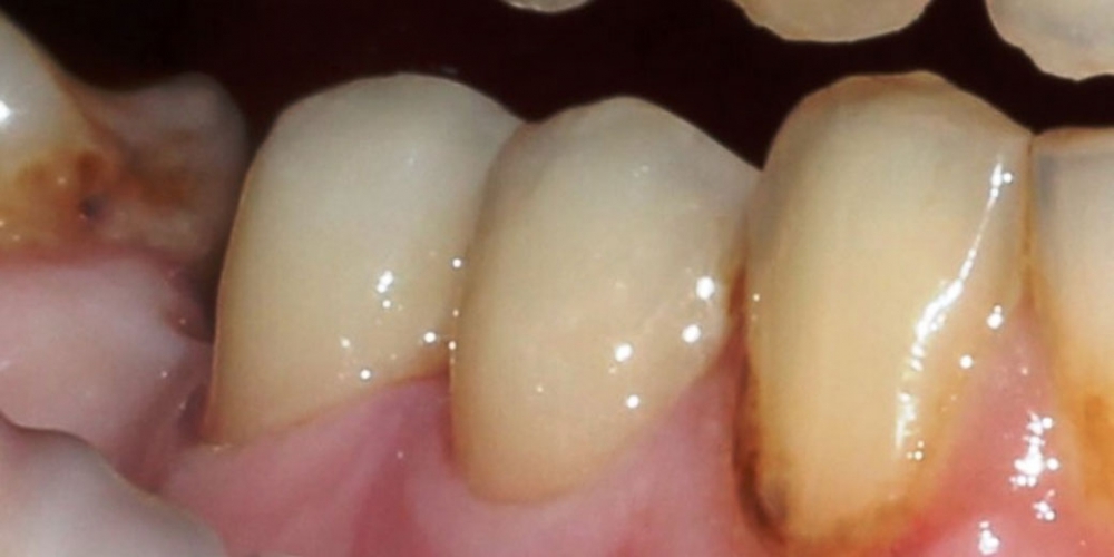 Результат лечения пришеечного кариеса зубов - фото №2