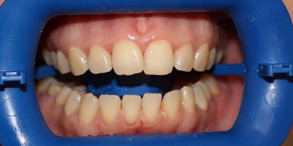 Результат отбеливания зубов с использованием системы Zoom-3 - фото №1