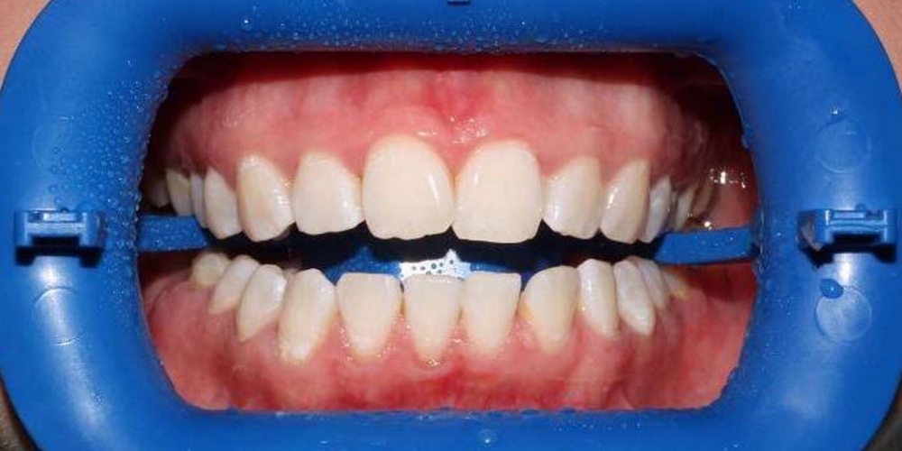 Результат отбеливания зубов с использованием системы Zoom-3 - фото №2