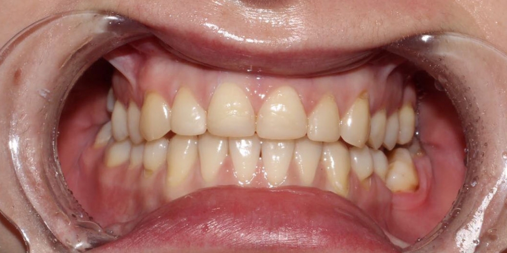 Протезирование верхних зубов керамическими коронками E.max - фото №1