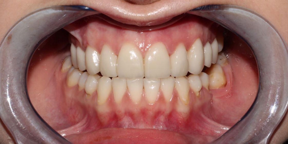 Протезирование верхних зубов керамическими коронками E.max - фото №3