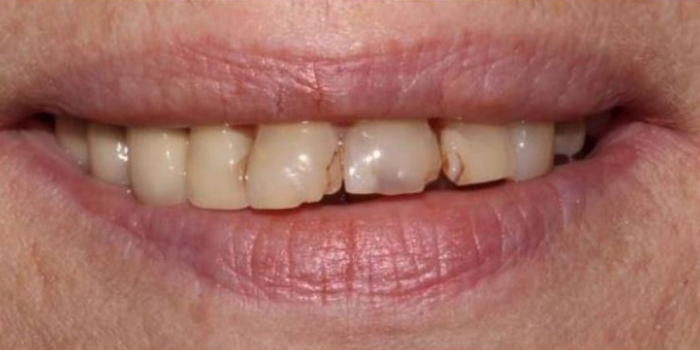 Протезирование зубов верхней челюсти металлокерамическими и керамическими коронками - фото №1