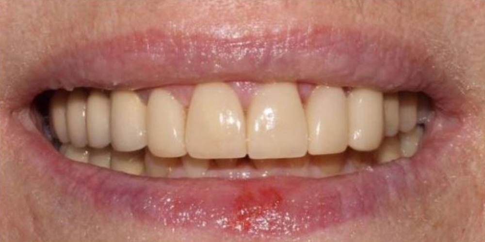 Протезирование зубов верхней челюсти металлокерамическими и керамическими коронками - фото №2
