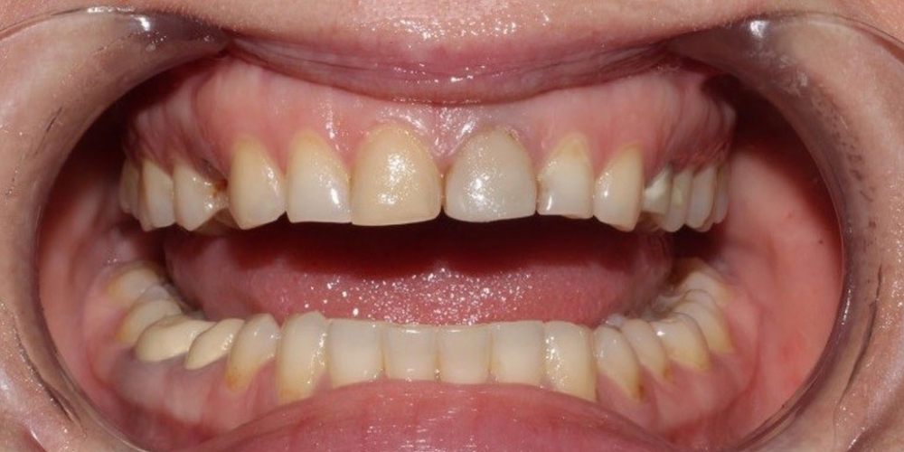 Протезирование центральных зубов верхней челюсти керамическими винирами - фото №1