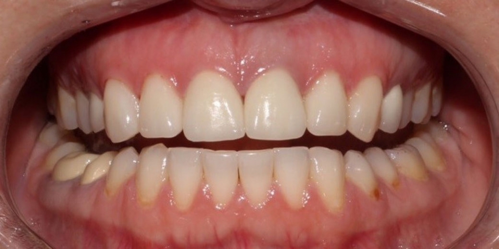 Протезирование центральных зубов верхней челюсти керамическими винирами - фото №2