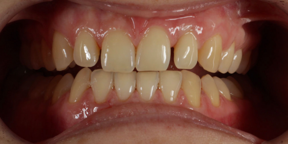 Восстановление центральных зубов верхней челюсти керамическими винирами E.max и отбеливание Zoom 3 - фото №1