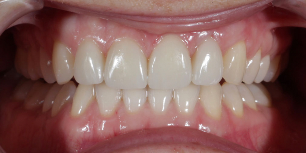 Восстановление центральных зубов верхней челюсти керамическими винирами E.max и отбеливание Zoom 3 - фото №2