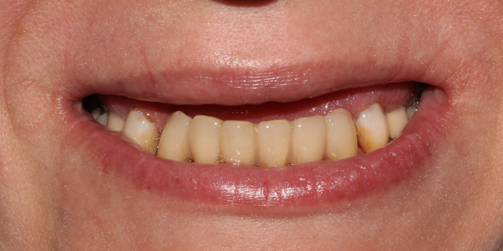 Протезирование условно-съёмными протезами на верхней челюсти (балочное соединение на 4 имплантатах) - фото №1