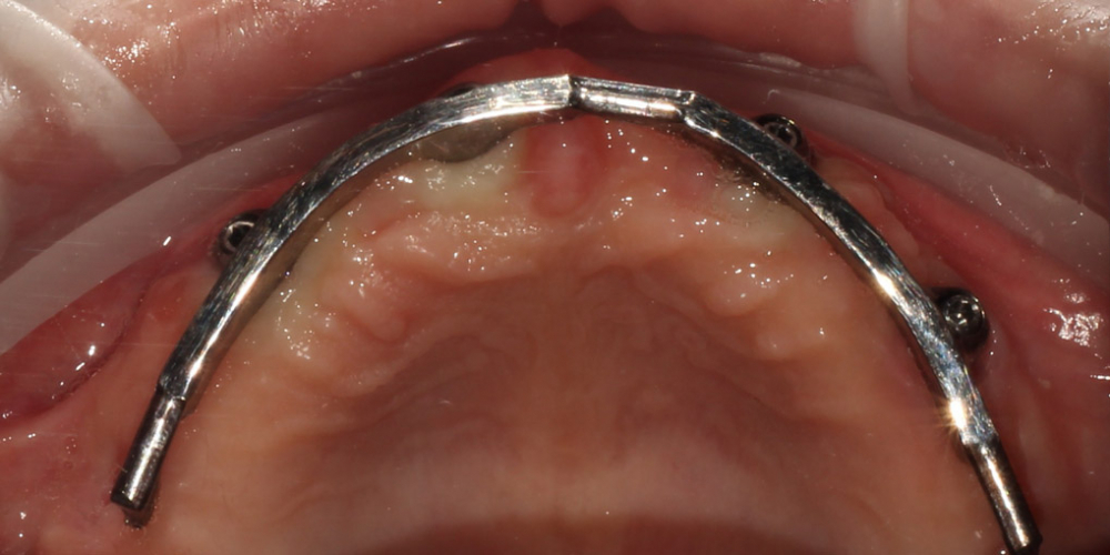 Протезирование условно-съёмными протезами на верхней челюсти (балочное соединение на 4 имплантатах) - фото №4
