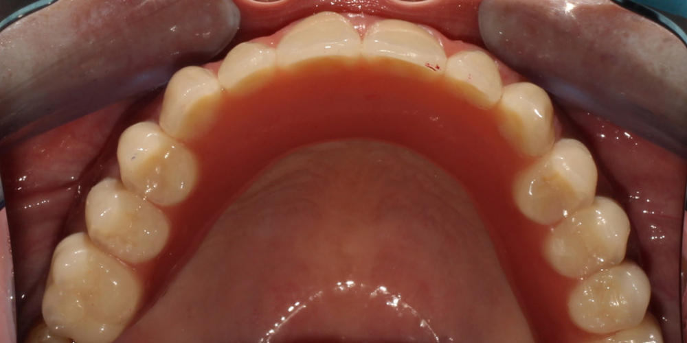 Протезирование условно-съёмными протезами на верхней челюсти (балочное соединение на 4 имплантатах) - фото №2
