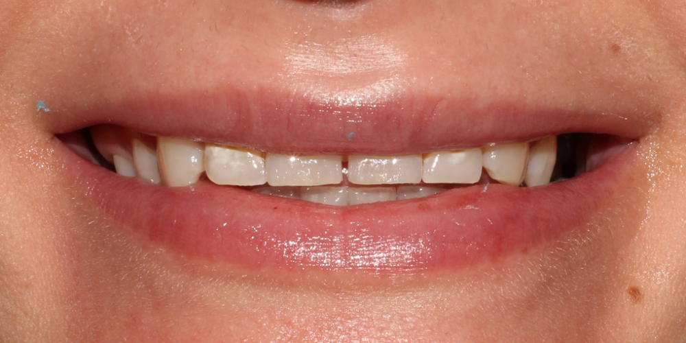 Восстановление зубов верхней челюсти керамическими винирами E.max - фото №1