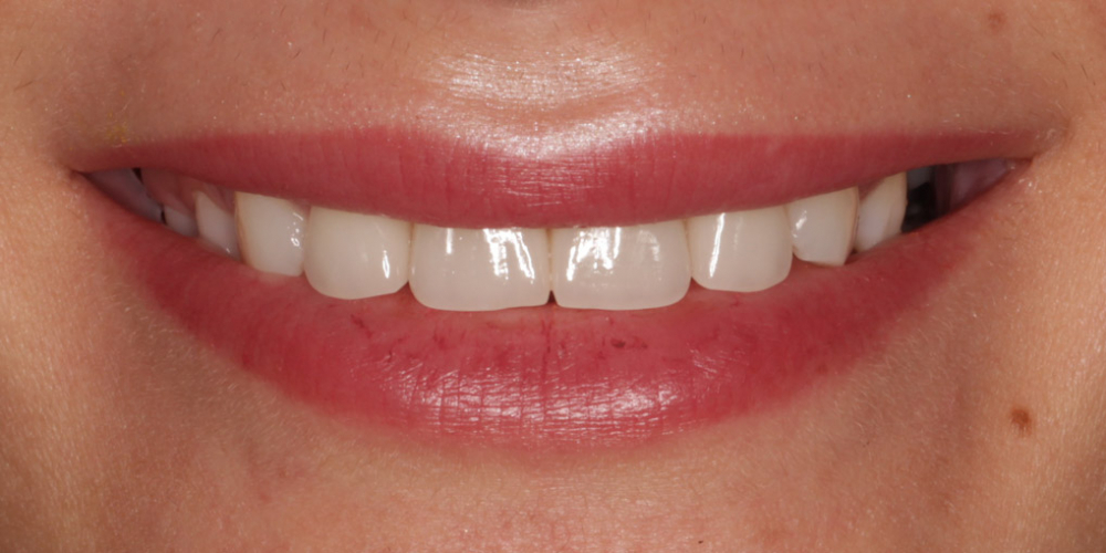 Восстановление зубов верхней челюсти керамическими винирами E.max - фото №4