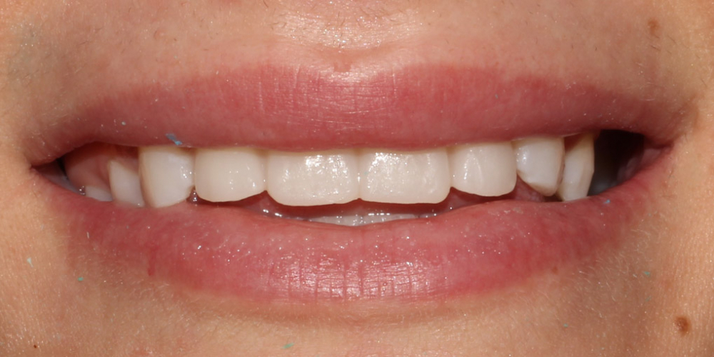 Восстановление зубов верхней челюсти керамическими винирами E.max - фото №3