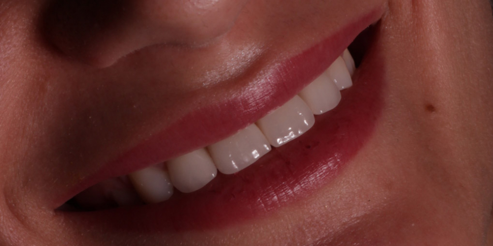 Восстановление зубов верхней челюсти керамическими винирами E.max - фото №2
