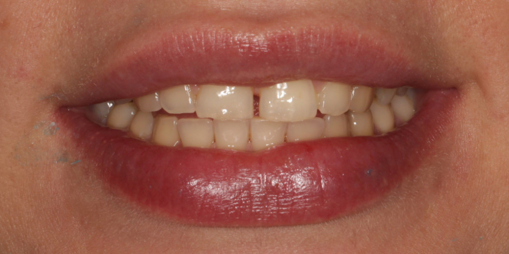 Восстановление центральных зубов верхней челюсти керамическими винирами E.max и отбеливание Zoom 3 - фото №1