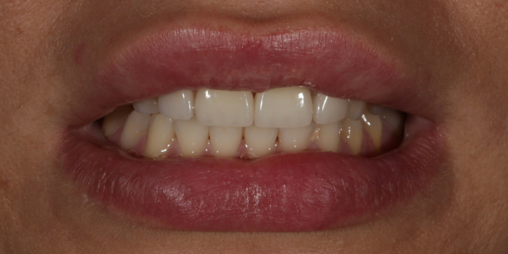 Восстановление центральных зубов верхней челюсти керамическими винирами E.max и отбеливание Zoom 3 - фото №2