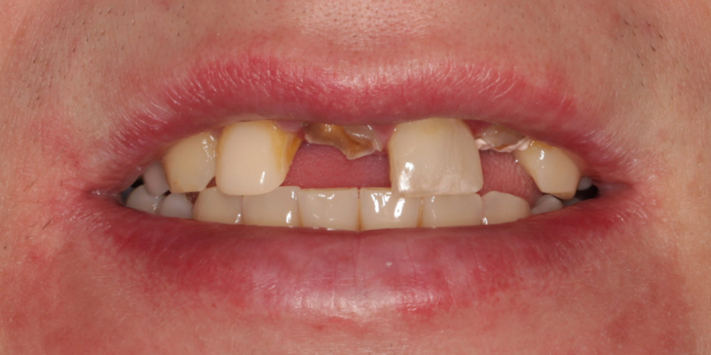 Восстановление центральных зубов верхней челюсти коронками на основе диоксида циркония - фото №1