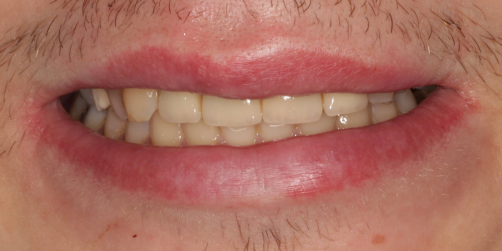 Восстановление центральных зубов верхней челюсти коронками на основе диоксида циркония - фото №2